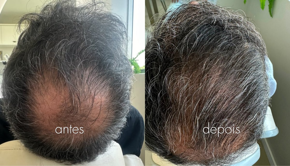 Antes e depois de tratamento capilar