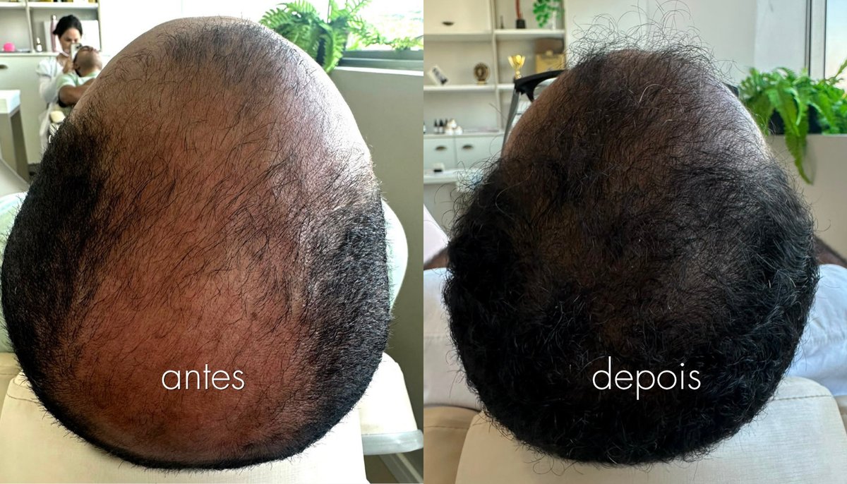 Antes e depois de tratamento capilar