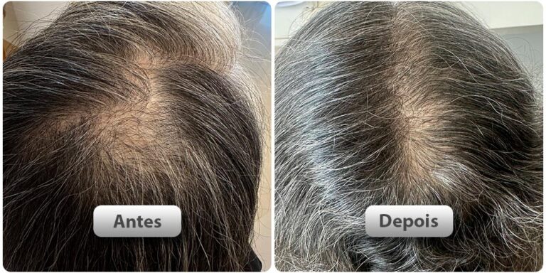 antes-depois31