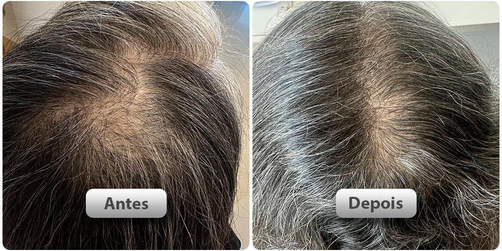 antes-depois31