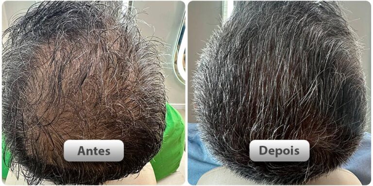 antes-depois51