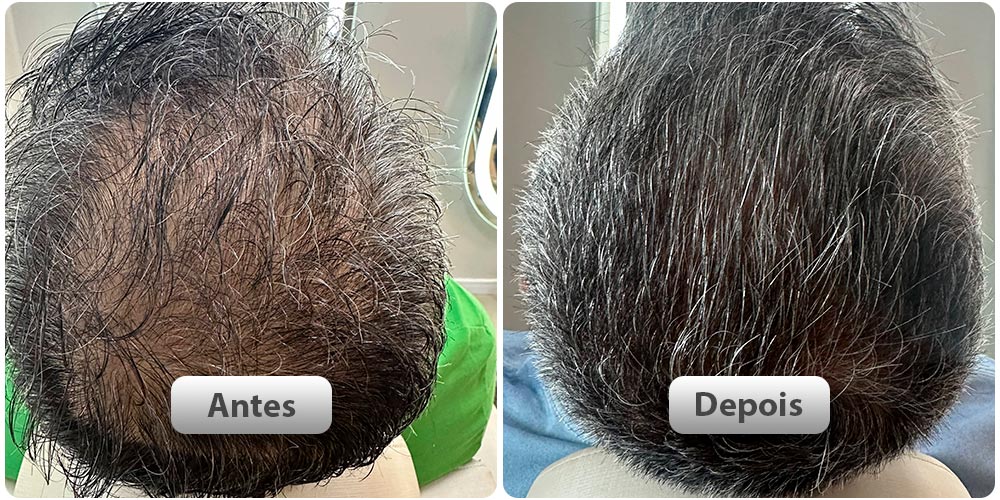 antes-depois51